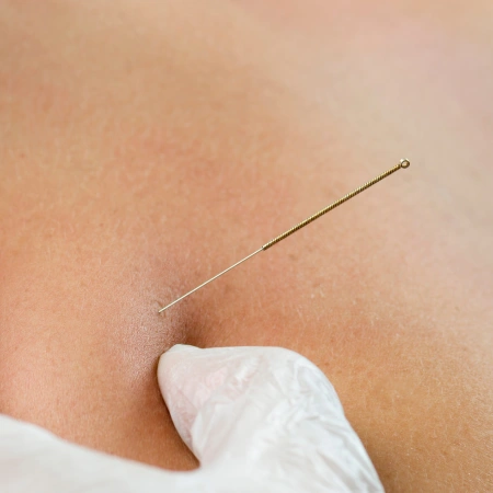 Dry Needling